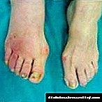 Këmbët e djegies në diabet: trajtimi i skuqjes së gishtërinjve dhe këmbëve